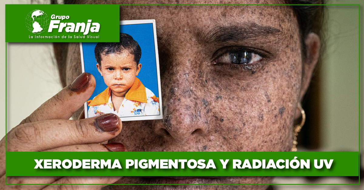 Xeroderma pigmentosa y radiación UV