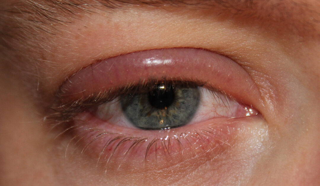 Tratamiento de la blefaritis