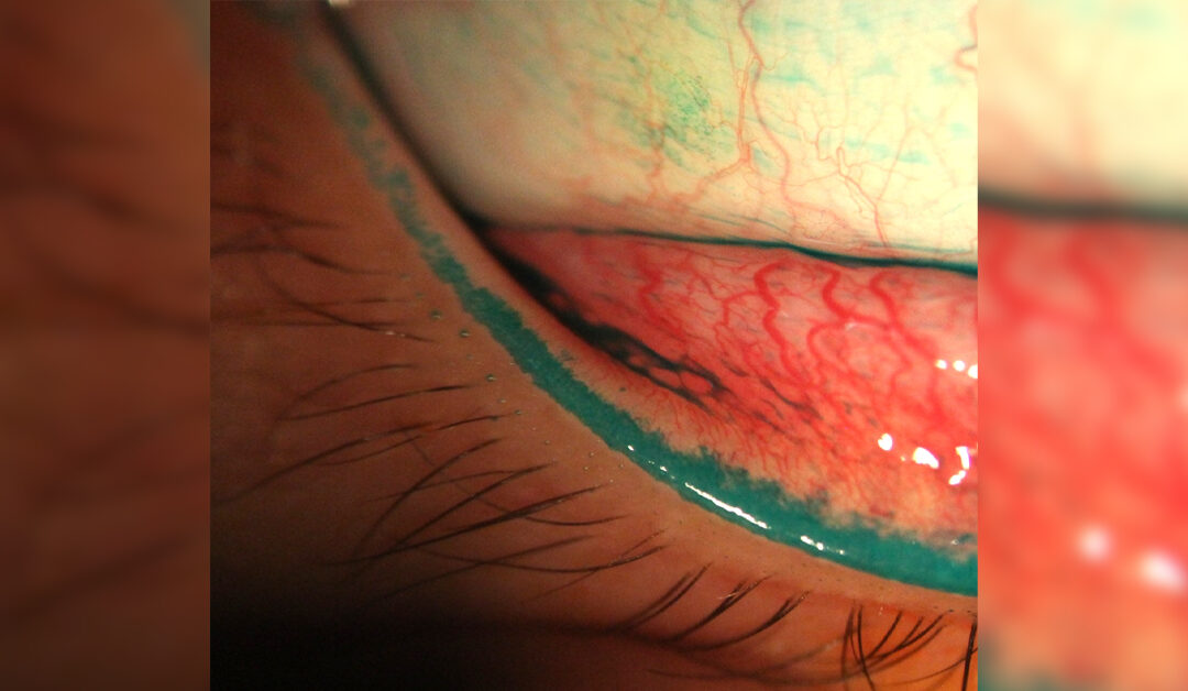 Uso de lentes de contacto y su relación con Epiteliopatía Lid Wiper