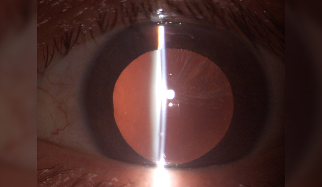 Influencia del estado refractivo en la formación de catarata cortical
