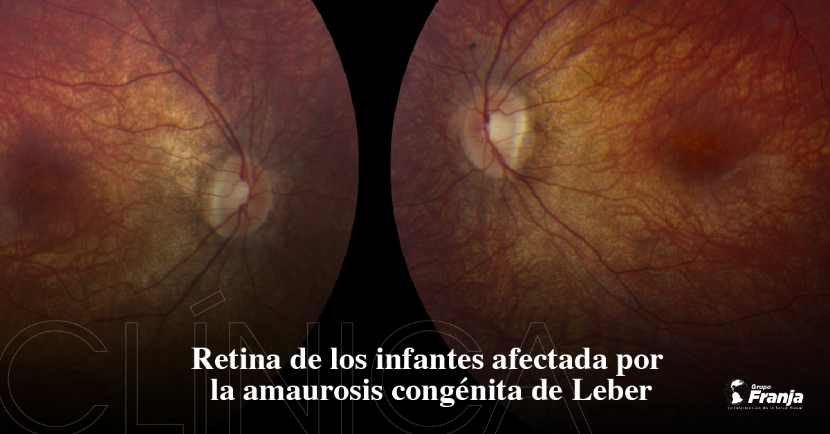 Retina de los infantes afectada por la amaurosis congénita de Leber