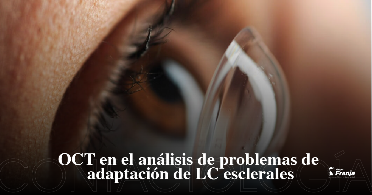 OCT en el análisis de problemas de adaptación de LC esclerales