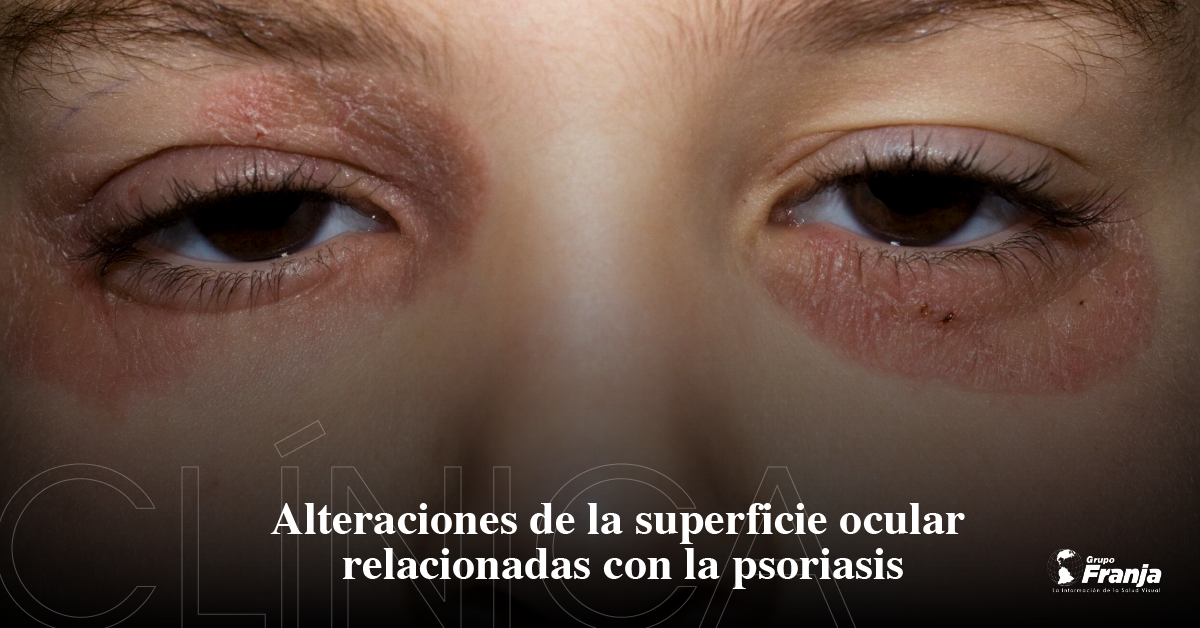 Alteraciones de la Superficie Ocular relacionadas con la psoriasis