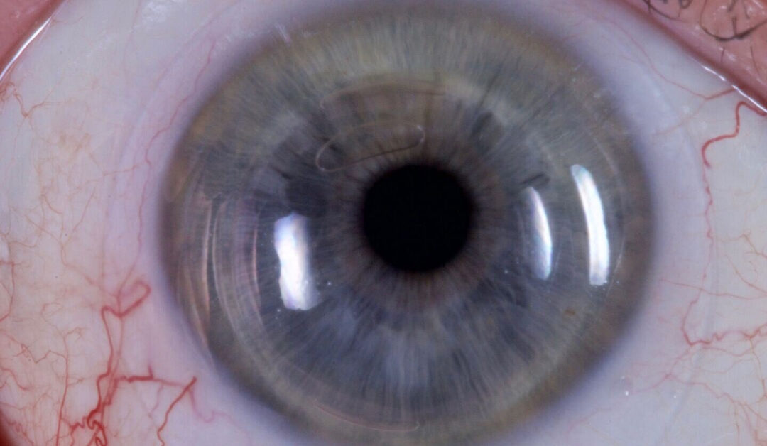 Incorporación de la corrección de HOA en Lentes esclerales personalizados