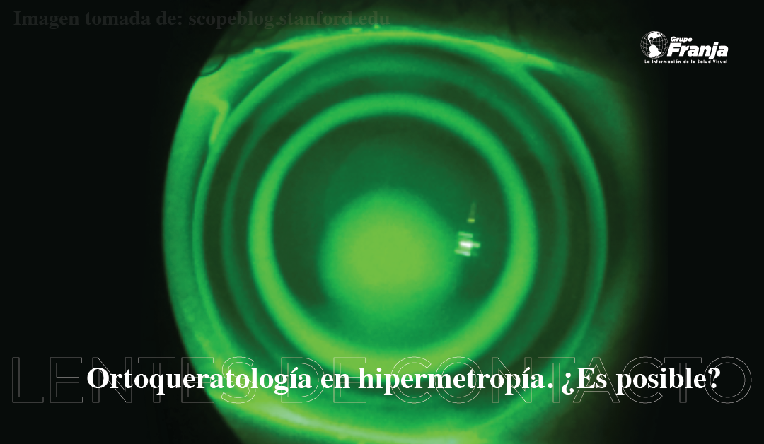 Ortoqueratología en hipermetropía. ¿Es posible?