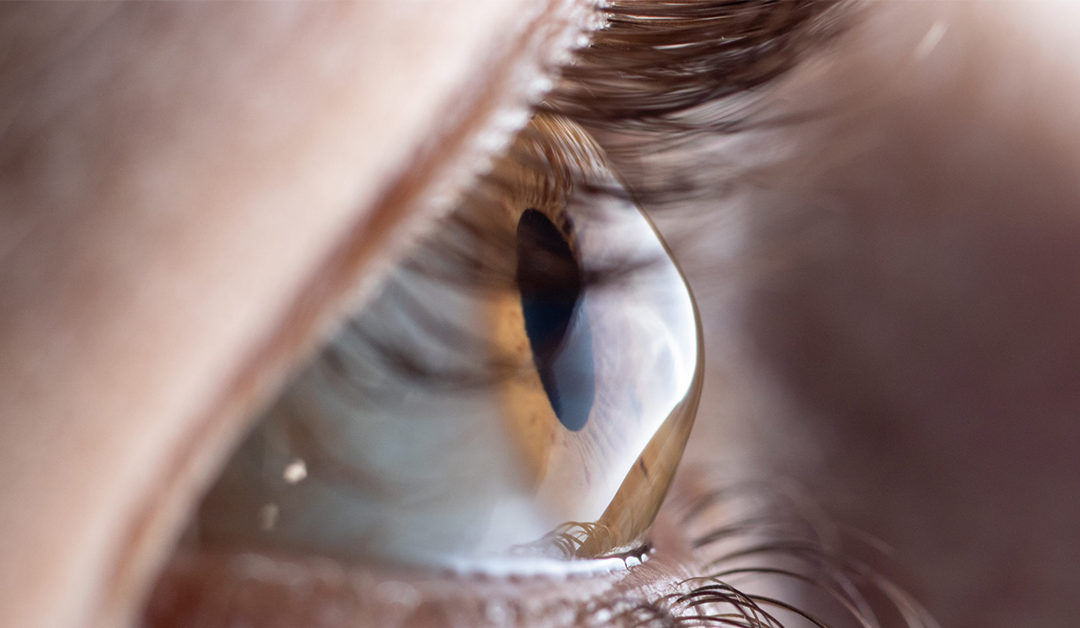 ¿Cómo manejan los profesionales el queratocono?