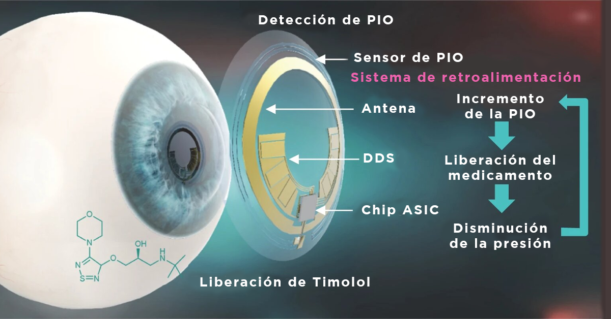 Nuevo LC inteligente para vigilar y controlar la presión intraocular en el glaucoma