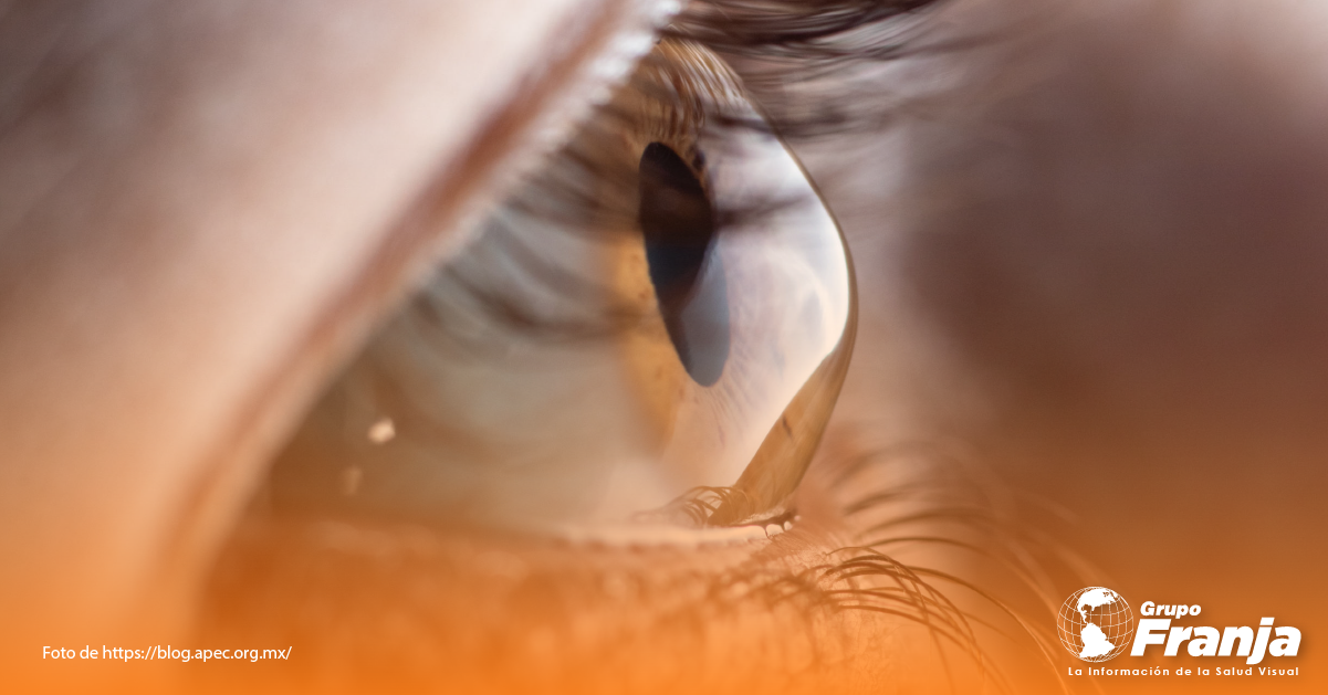 Queratocono: técnica novedosa y prometedora