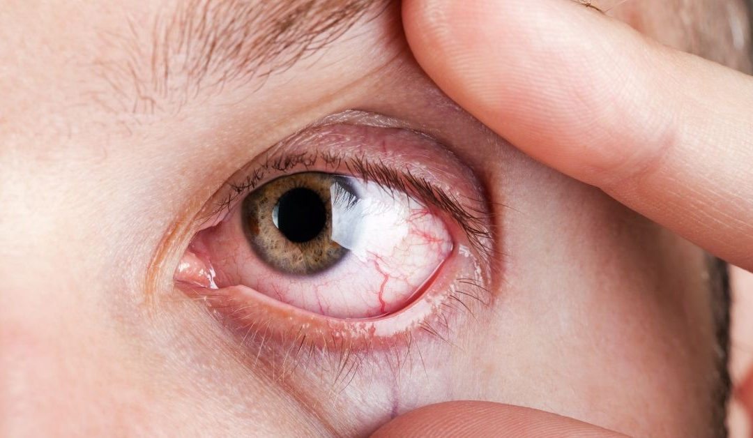 Isotretinoína oral, un abordaje sistémico y ocular