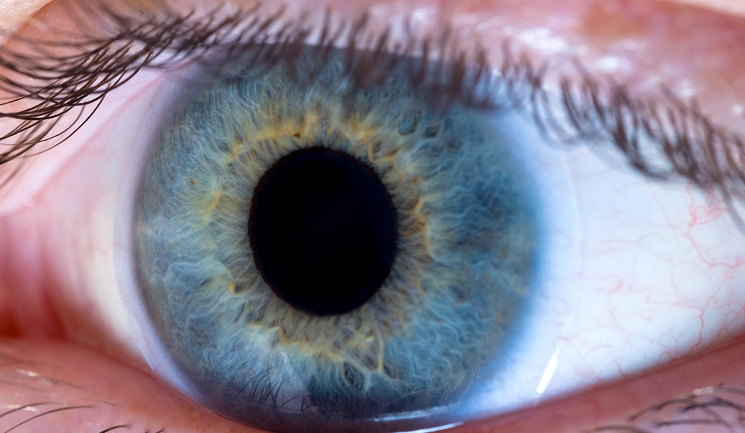 LC como vendaje en el tratamiento de la queratitis neurotrófica