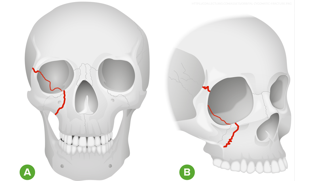 Síndrome compartimental orbitario, un evento traumático