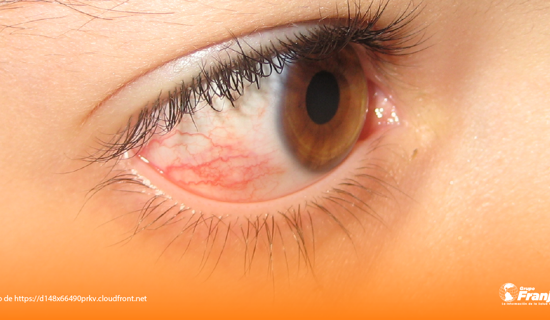 Un abordaje de la epiescleritis