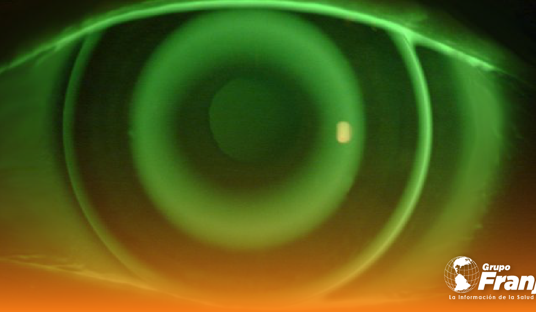 Factores que influyen en el tamaño de la zona de tratamiento en ortoqueratología