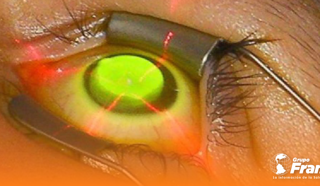 Crosslinking asistido por lentes de contacto, una alternativa para ectasias con paquimetrías muy delgadas