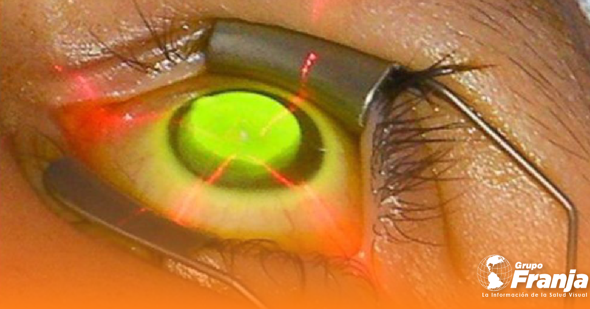 Crosslinking asistido por lentes de contacto, una alternativa para ectasias con paquimetrías muy delgadas