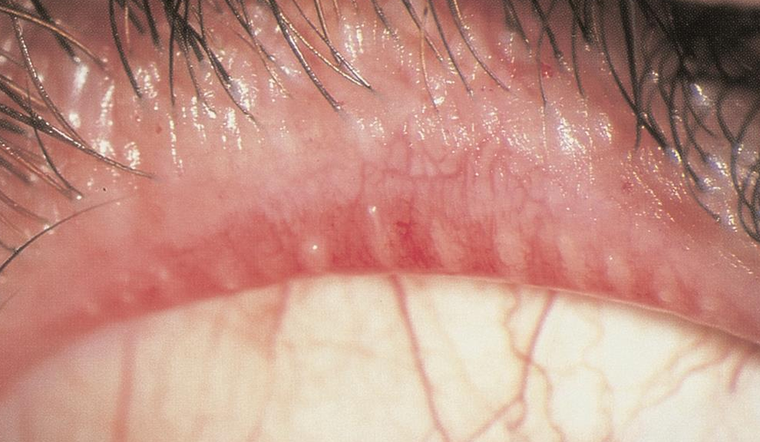 Tetraciclinas y azitromicina en el tratamiento de la disfunción de glándulas de meibomio