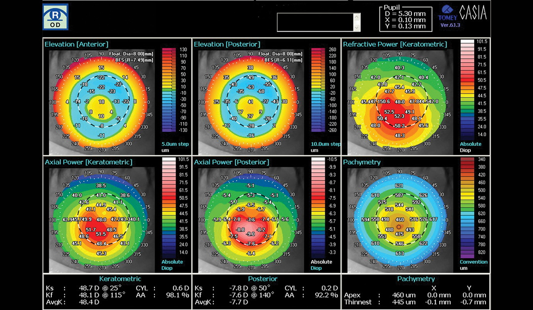 Uso de la topografía corneal para evaluar los LC para el manejo de la miopía