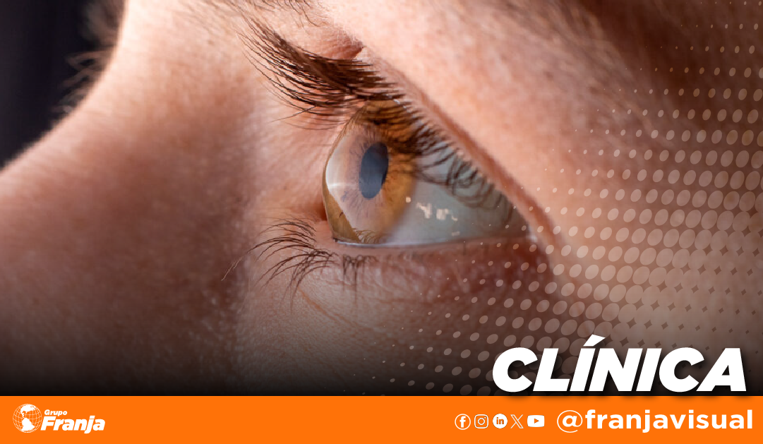 Queratocono pediátrico semiología