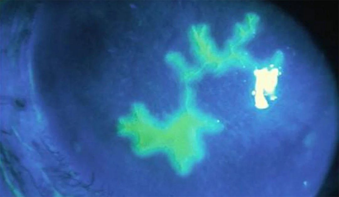 Queratitis estromal por virus del herpes simple. Patogénesis