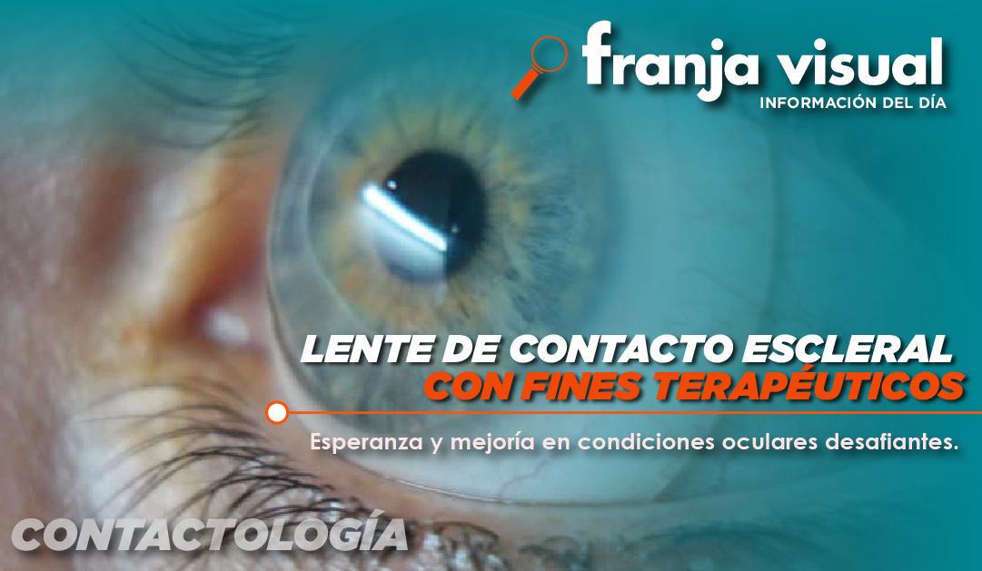 Lente de contacto escleral con fines terapéuticos