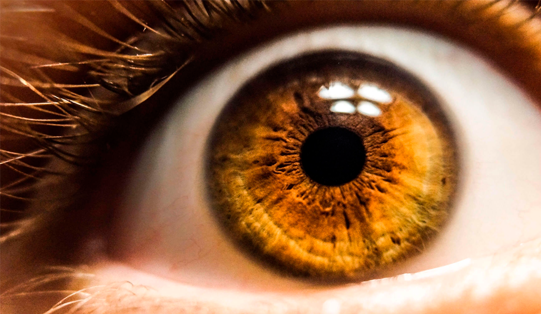 Síndrome de dispersión pigmentaria. Aspectos clave