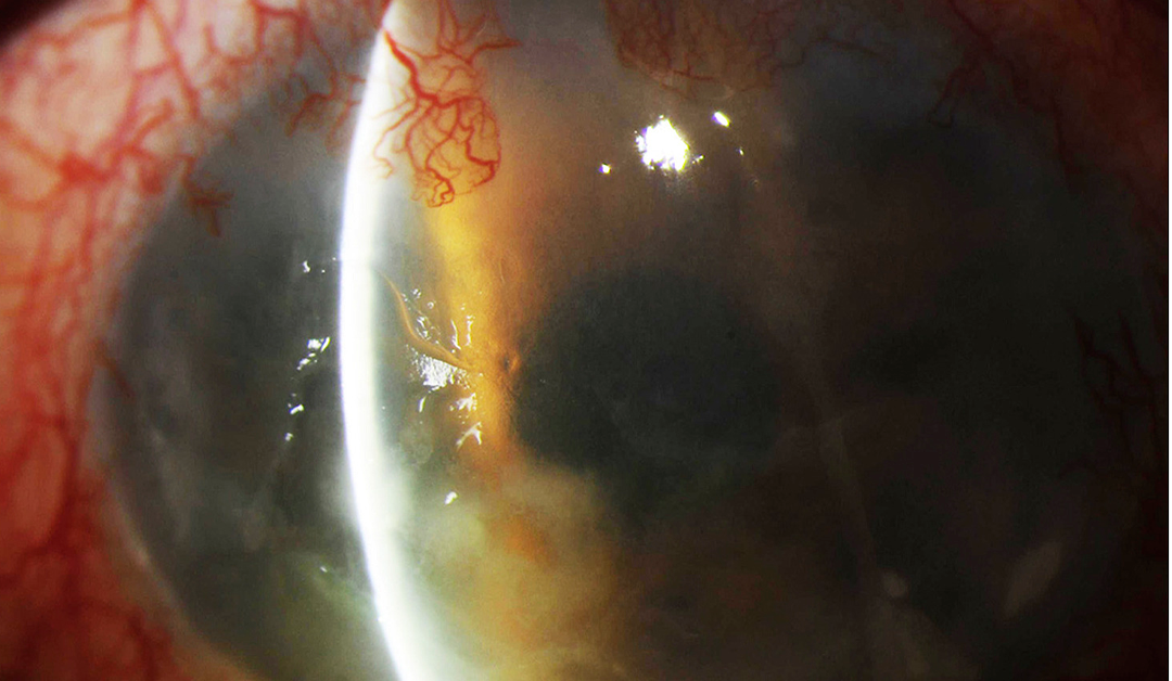 Queratitis por Achromobacter Xylosoxidans, una afección rara, pero emergente