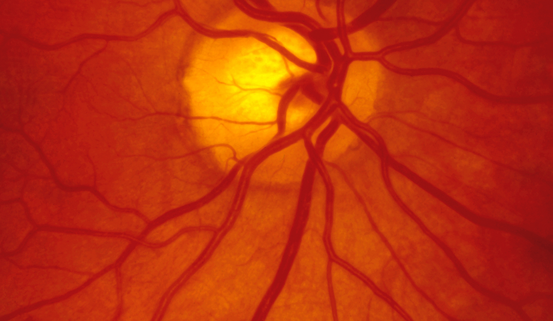 El estrés oxidativo en el glaucoma: ¿Los antioxidantes pueden ser una alternativa terapéutica?