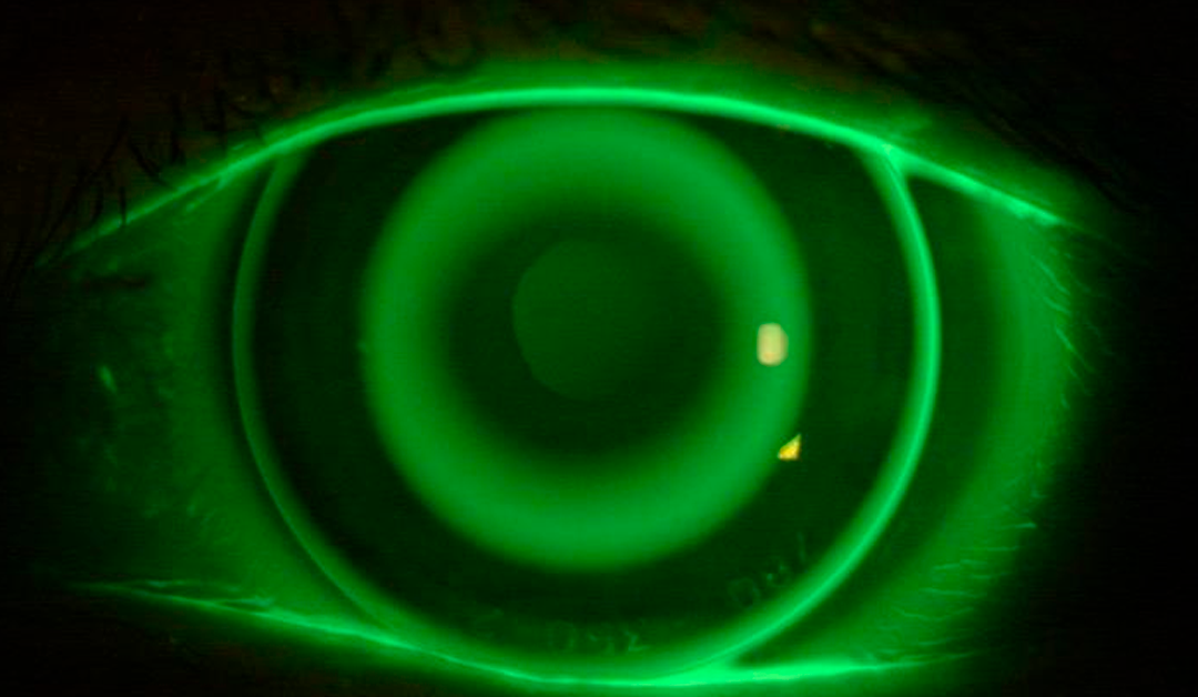 Precaución con ortoqueratología en niños y adolescentes con conjuntivitis alérgica