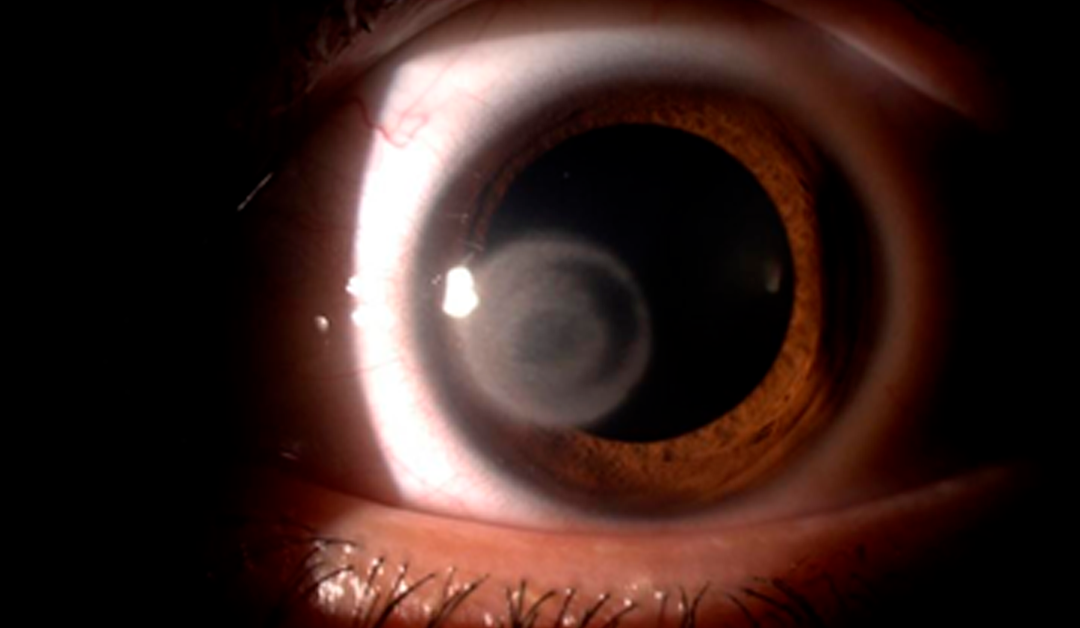 Queratitis por Acanthamoeba en LC híbridos: Una afección rara pero agresiva