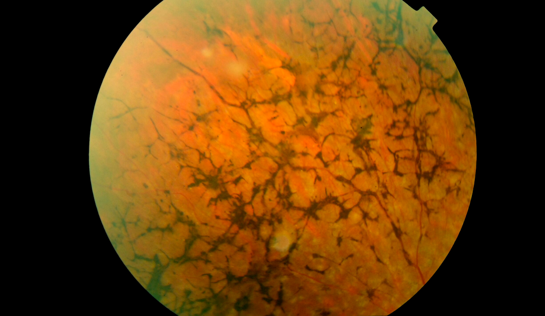 Recursos Para La Baja Visión “Retinosis Pigmentaria”