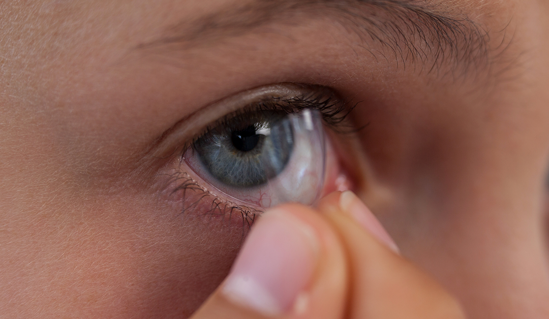 Perfil de potencia en LC multifocales para el manejo de la miopía