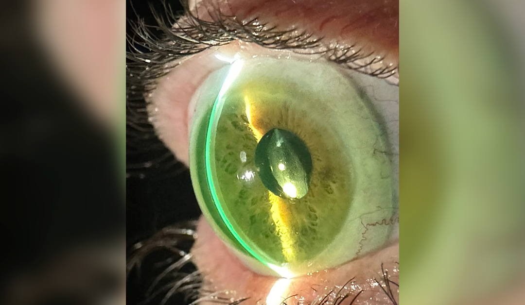 Rehabilitación visual integral en ectasia corneal iatrogénica Post-LASIK mediante lente escleral Free Form personalizado