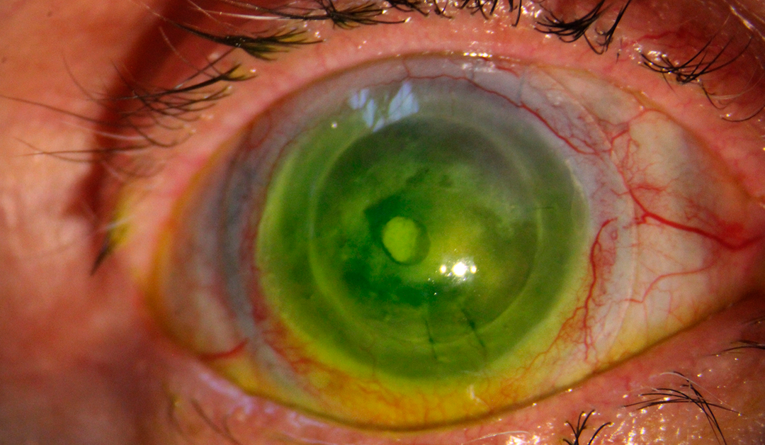 De la discapacidad visual a la rehabilitación: impacto de los lentes esclerales en la superficie ocular