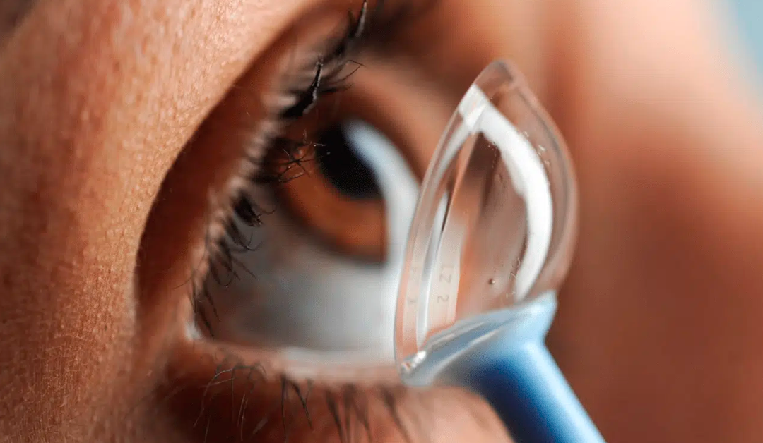 Hialuronato en lentes esclerales: ¿mejora real del contraste?